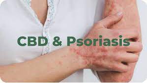 Le CBD et le Psoriasis